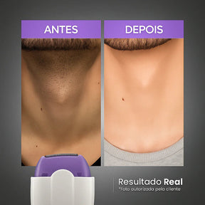 Depilador Elétrico Facial e Corporal Recarregável Sem Dor – Ideal para Homens e Mulheres | Modernara