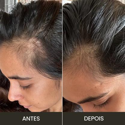 Massageador Elétrico para Couro Cabeludo / Crescimento e Nutrição Natural